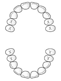 子供の虫歯の特徴