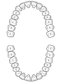 大人の虫歯の特徴