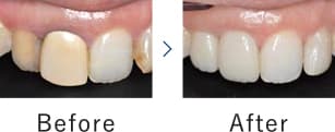 プロセラ・オールセラミックシステムで治療を！