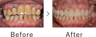 プロセラ・オールセラミックシステムで治療を！