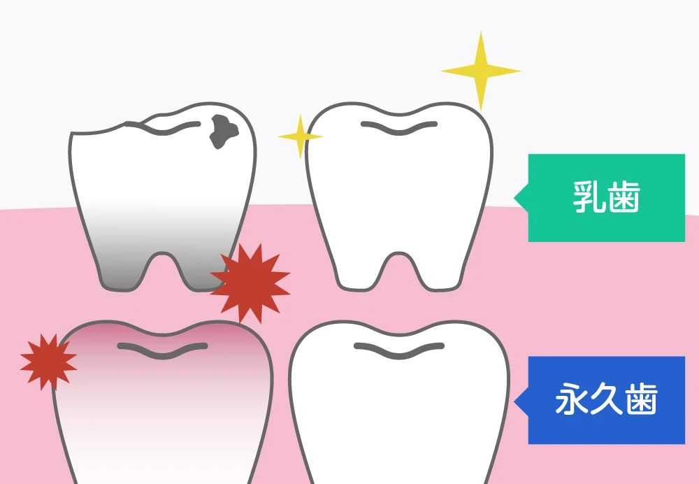 乳歯の虫歯が将来に与える影響