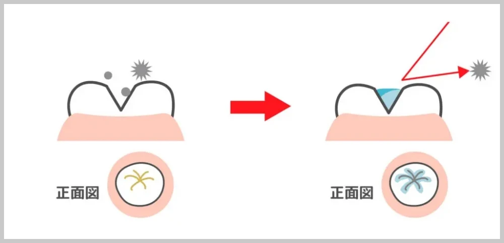 シーラント