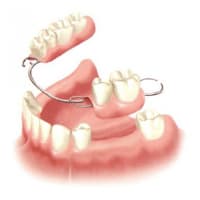 部分入れ歯（部分義歯）