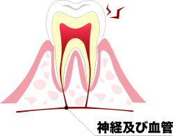 歯髄充血（初期）