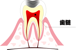 歯髄炎