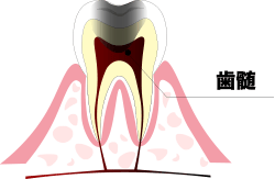 歯髄壊死