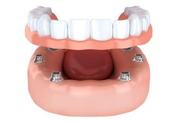 インプラントを使用した入れ歯とは？