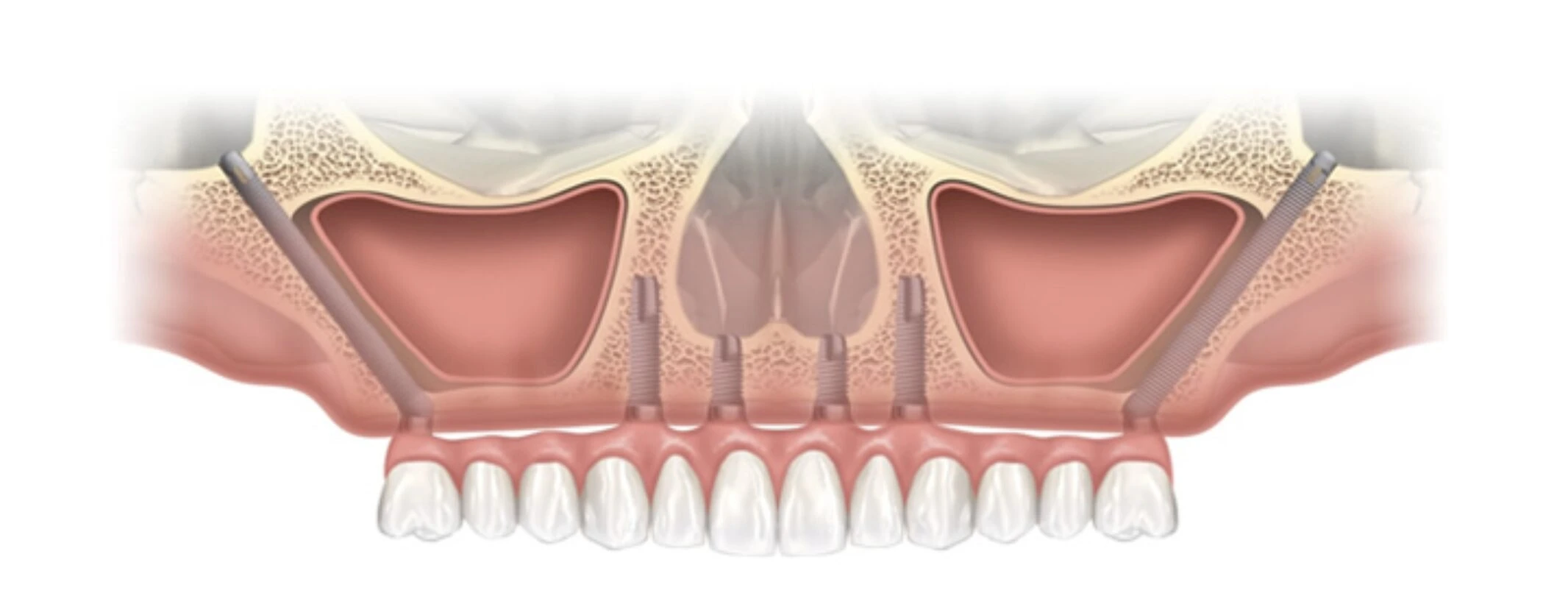 ザイゴマ・プテリゴイドインプラント