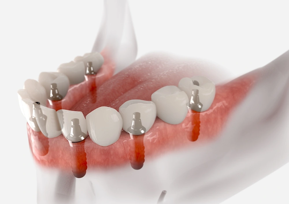 少ないインプラントで歯全体を支えるAll-on-X（オールオンエックス）
