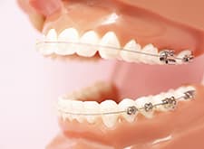 全体矯正：歯の表側からの矯正治療