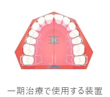 一期治療で使用する装置