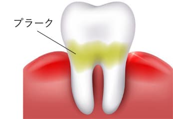 歯周病の原因とは？