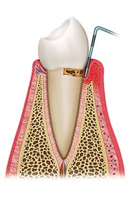 そもそも歯周病の原因は？